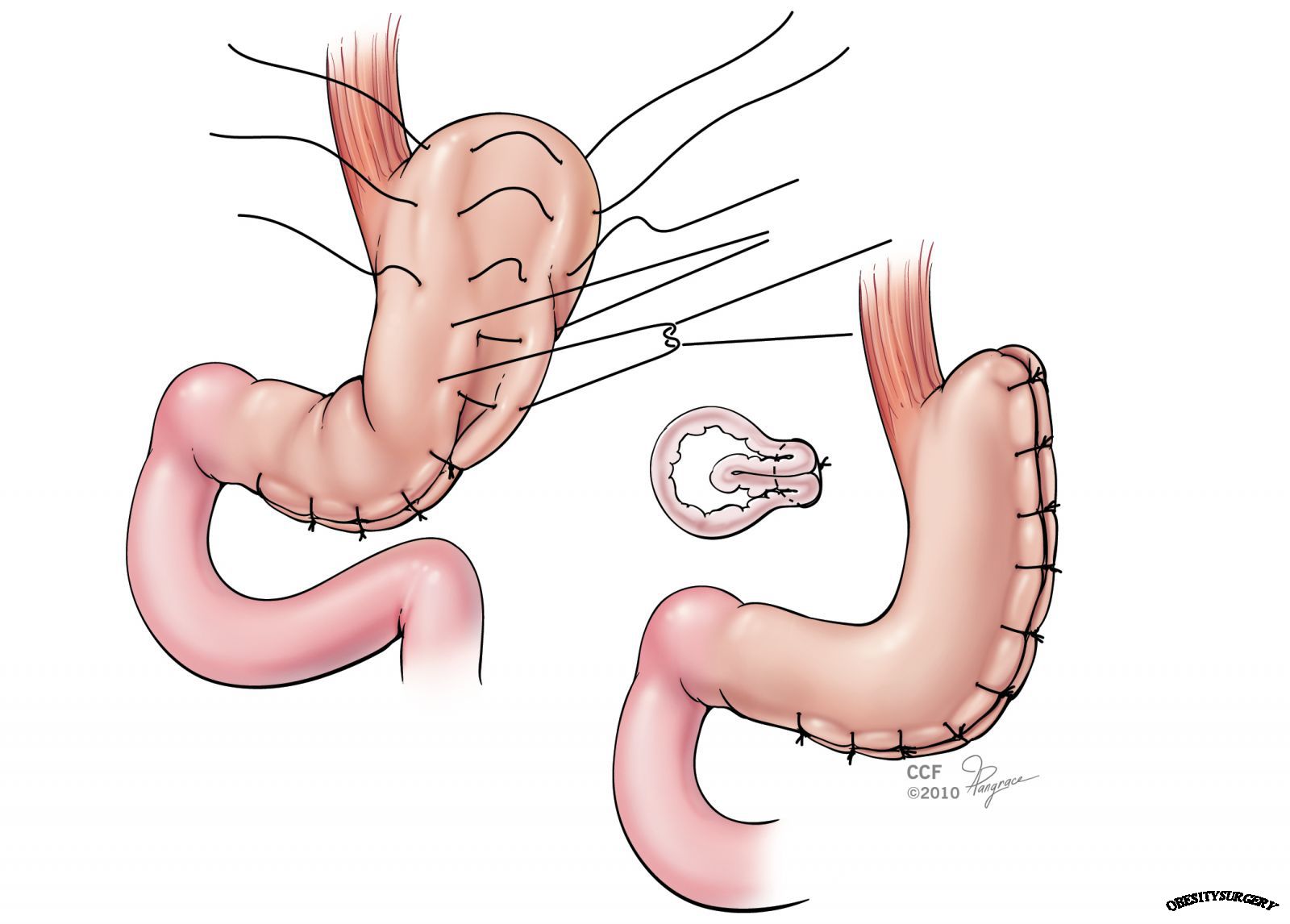 Laparoscopic Sleeve Gastrectomy, Sleeve, Bariatric surgery